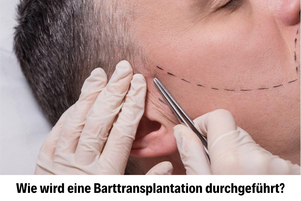 Barttransplantation